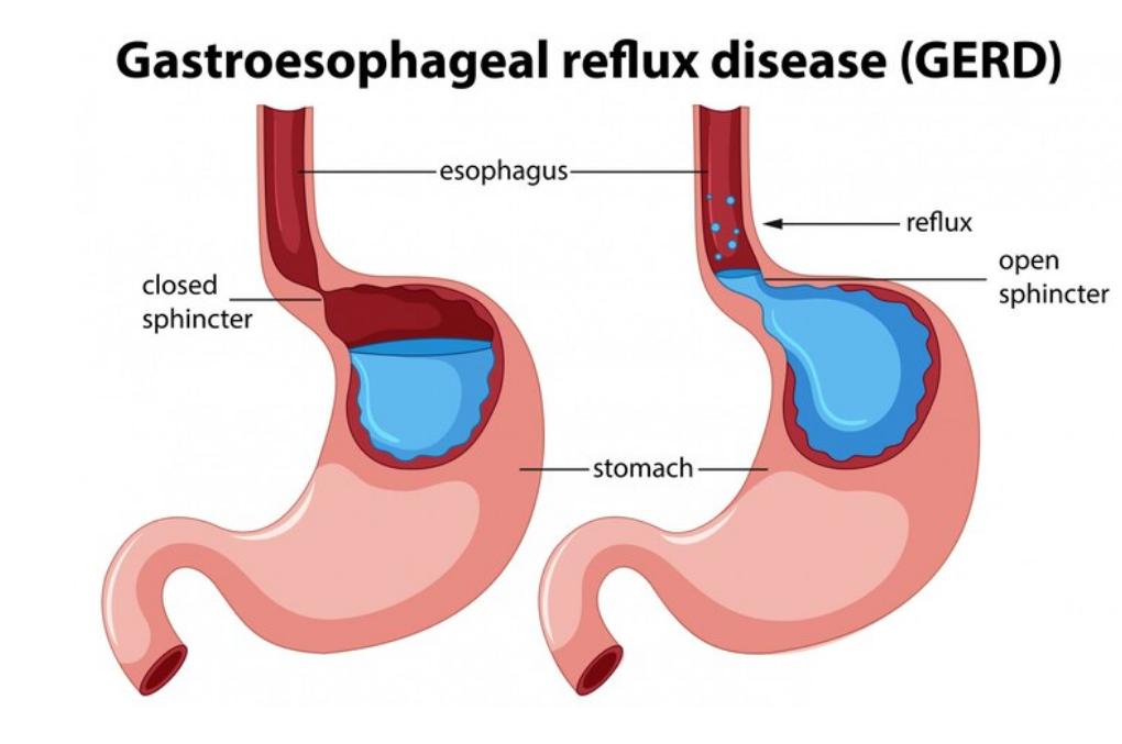  اسباب حرقة المعدة